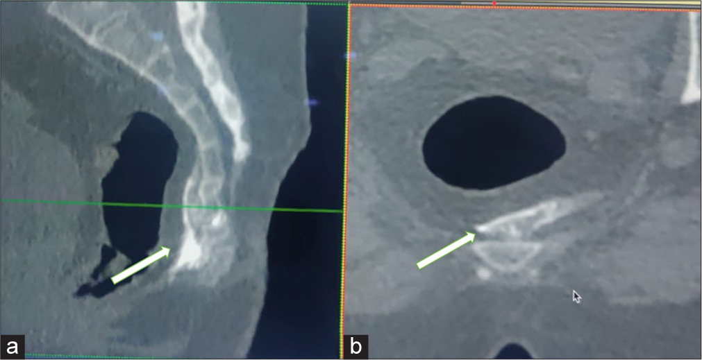 Sagittal (a) and axial (b) reformatted computed tomography images of the pelvis show the final spread of injectate (arrow) mixed with non-ionic contrast for ganglion impar block in precoccygeal space.