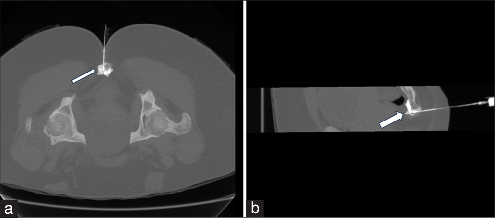 The patient is placed in a prone position. Axial (a) and sagittal (b) computed tomography in maximum intensity projection depict needle position and spill of nonionic iodinated contrast (arrow) in pre coccygeal plane for ganglion impar block.