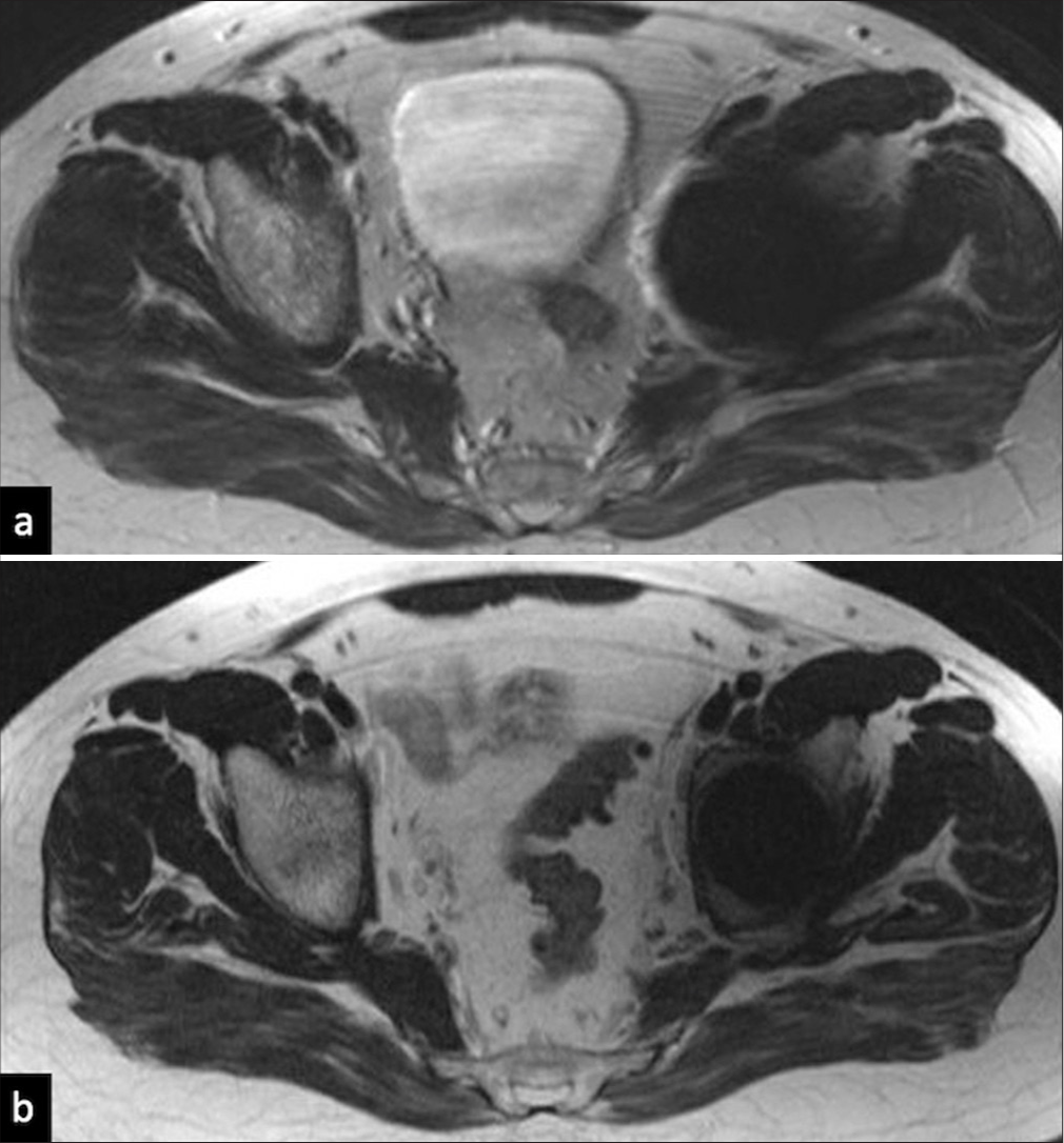 MRI without and with metal artefact reduction sequence (MARS). (a) Axial T2 image without MARS: metallic artifact causing marked hypointensity around the prosthesis causing obscuration of the left hip joint and the adjacent soft tissue, (b) Axial T2 MARS MRI (showing improved visualization of the acetabulum as well as the surrounding soft tissue.