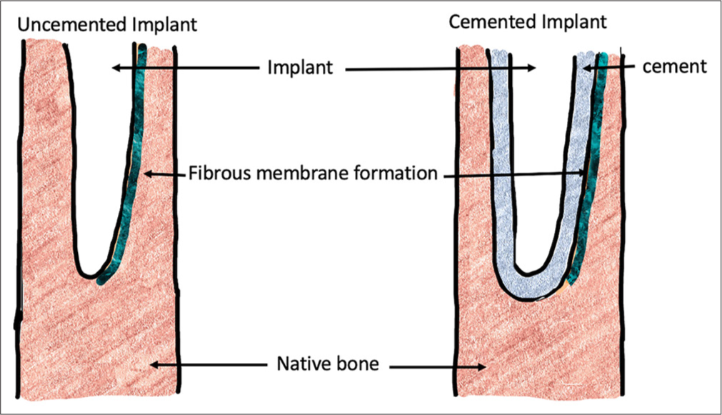 Periprosthetic bone resorption: Schematic showing fibrous membrane formation at the implant bone interface and cement bone interface in uncemented and cemented implants.