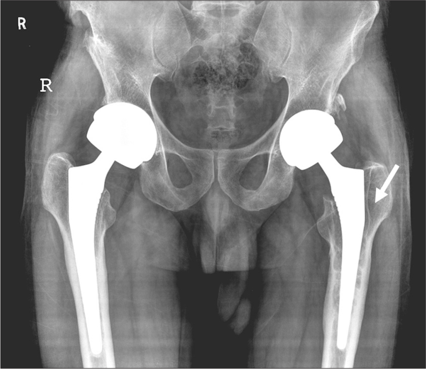 Osteolysis. Plain radiograph of the pelvis with both hips, showing linear lucency (white arrow) at the bone prosthesis interface of the left femur.