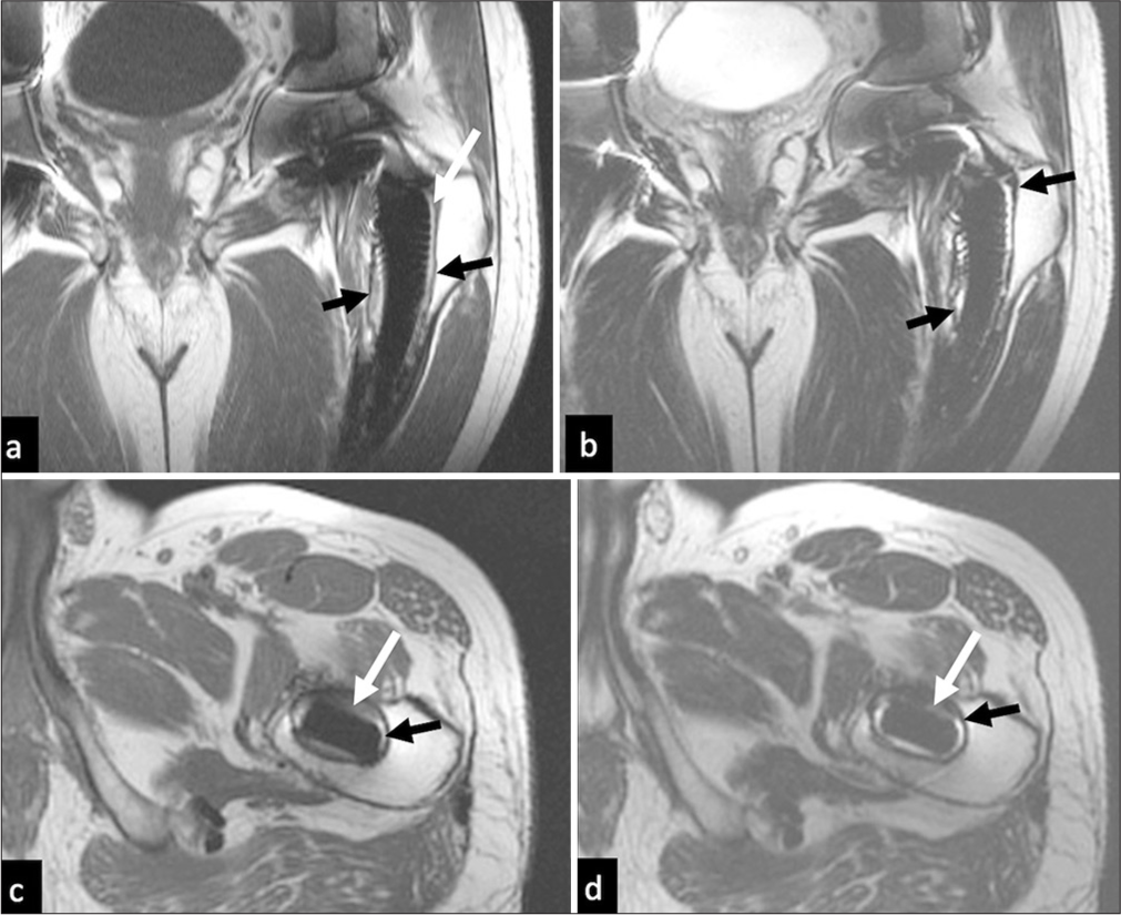 Osteolysis. MRI (a) Coronal T1, (b) T2, (c ) axial T1, and (d) T2 images show circumferential intermediate signal (white arrows in a-d) surrounded by a characteristic low-signal rim (black arrows in a-d) at the bone prosthesis interface encasing the stem of the prosthesis.