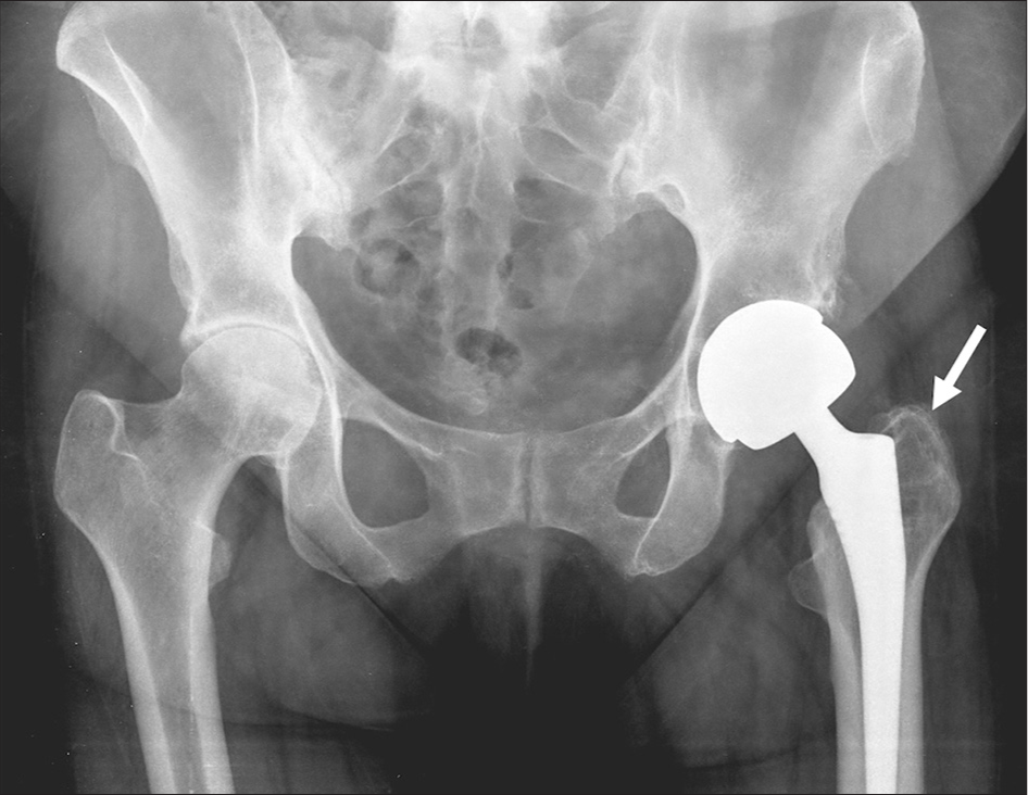 Focal osteolysis. Plain radiographs of the pelvis with both hips show focal osteolysis (white arrow) at the bone prosthesis interface of the left femur