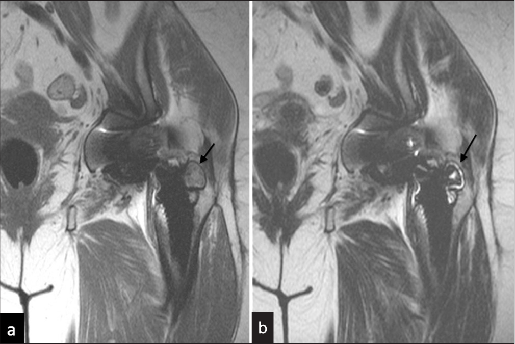 MRI (a) Coronal T1 and (b) T2, images demonstrate well- circumscribed focal lobulated areas of intraosseous increased T2-weighted signal change (black arrow) without any peri-osseous collection consistent with focal osteolysis.