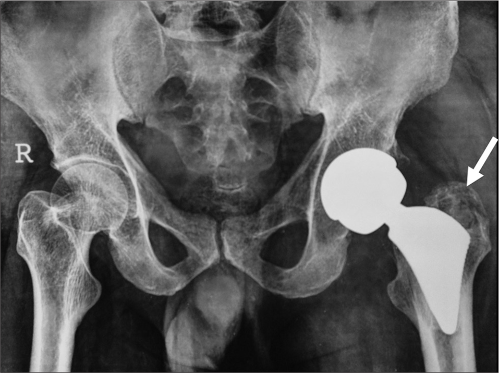 Infection. Plain radiographs of the pelvis with both hips, showing focal osteolysis (white arrow) at the bone prosthesis interface of the left femur with cortical irregularity.