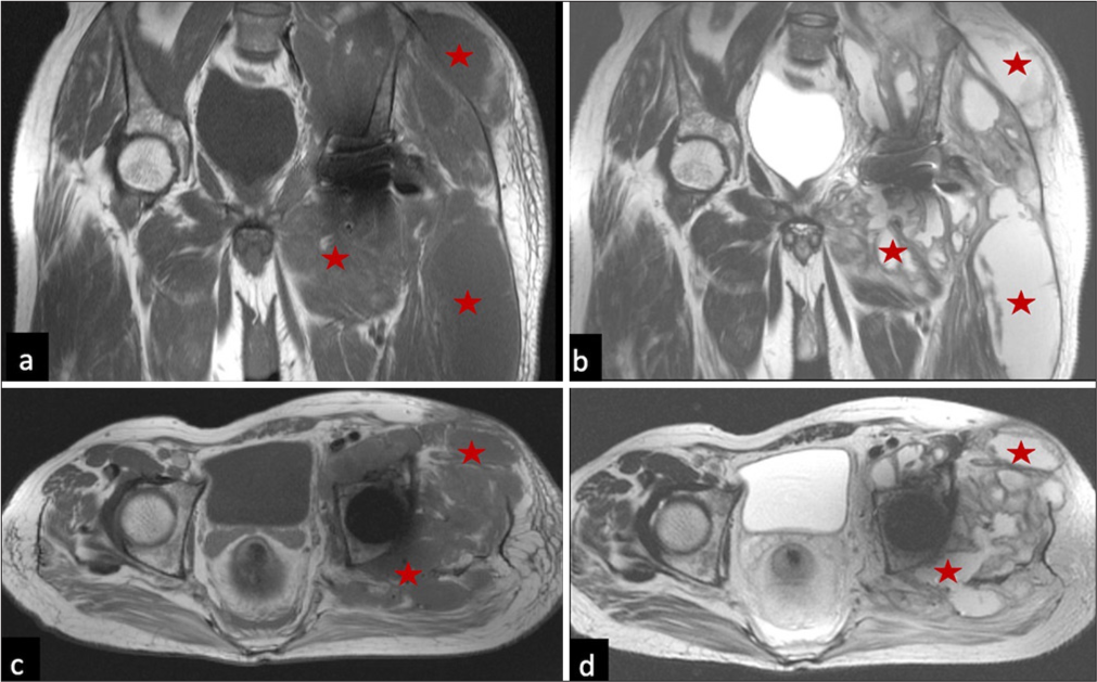 Infection. MRI (a) Coronal T1, (b) T2, (c) axial T1, and (d) T2 images show multiple pockets and a large loculated collection surrounding the left hip (red stars in a-d).