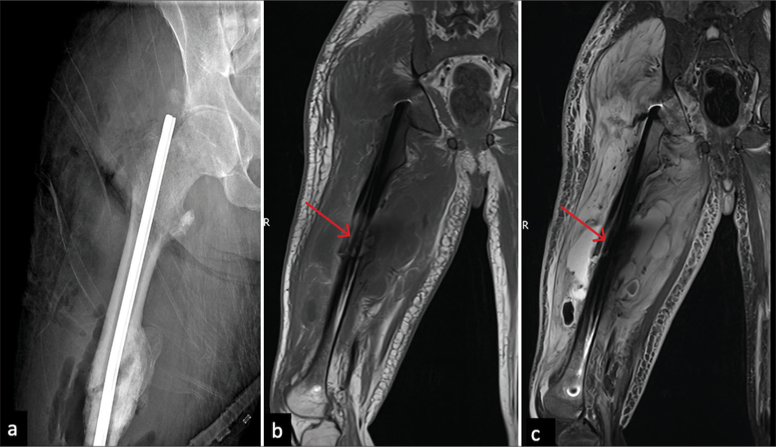 Infection. (a) Radiograph of the right femur showing an intramedullary nail for an oblique shaft fracture showing cortical thickening and solid periosteal reaction in the mid shaft around the fracture site, blurring of surrounding fat planes. (b) MRI Coronal T1 non-FS (Fat Suppressed) and (c) T2 FS reveals intermediate signal along the anterolateral cortex on T1 (red arrow in b) and linear fluid signal just deep to it on T2FS (red arrow in c) which is contiguous with large collection in the peri osseous soft tissue with surrounding extensive soft tissue edema. There is associated marrow edema in the proximal femoral shaft and right subchondral location of the right hip joint involvement.