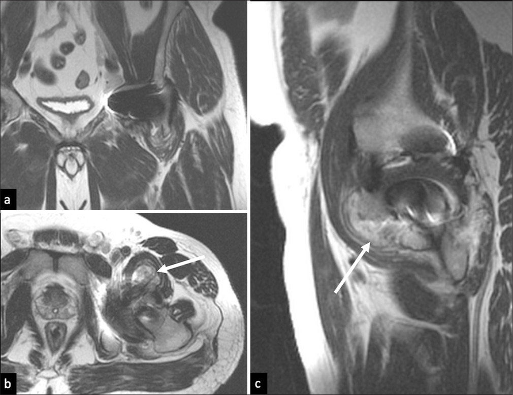 Polyethylene wear induced synovitis. (a) T2 nonfs Coronal, (b) axial, and (c) sagittal images show pseudo capsule distension with low to intermediate thick-walled synovial lining and heterogeneous intermediate signal intensity debris that has decompressed into the left iliopsoas bursa (white arrows).