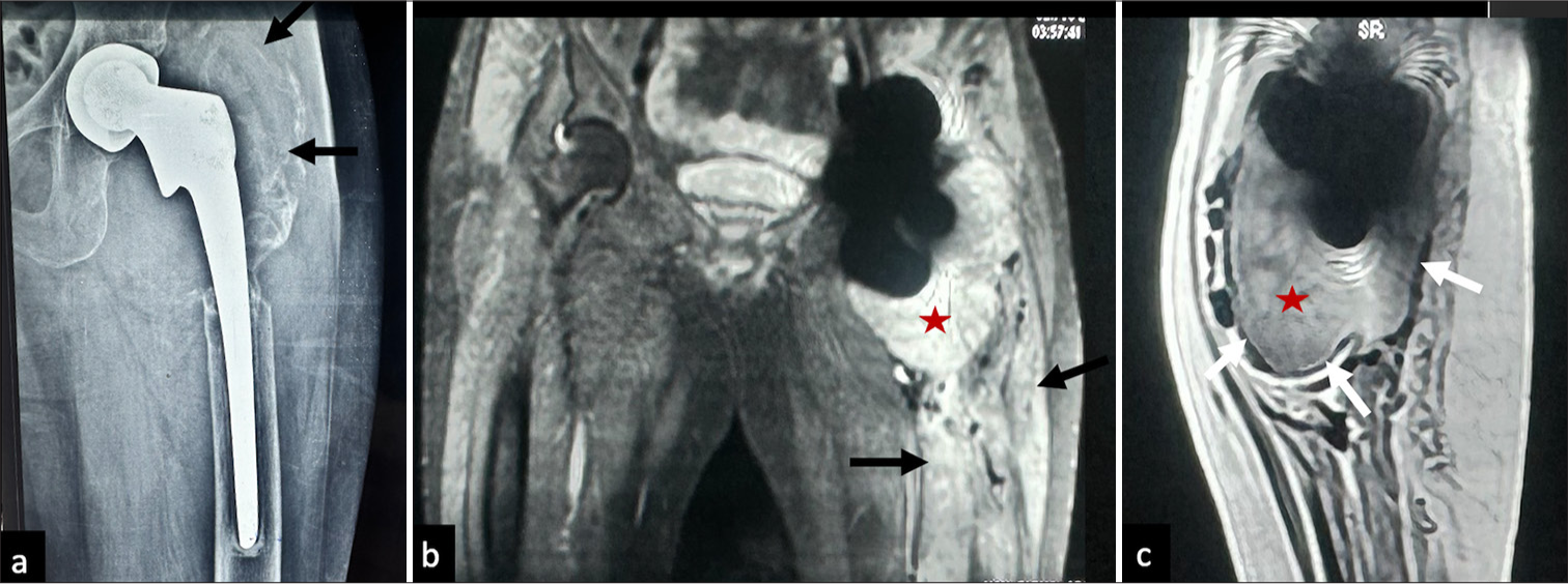 Adverse local tissue reactions caused by hypersensitivity to metal products (ALVAL) (a) Anteriorposterior radiograph left hip joint showing marked osteolysis around the femoral component involving the greater trochanter (black arrows). (b) Coronal STIR and (c) sagittal T2 non fs MR image of the same patient showing marked distension of pseudo capsule with thin hypointense lining (white arrows) and intermediate to hyperintense signal fluid content (red star in b and c), there is marked periprosthetic soft tissue edema in the visualized left proximal left thigh (black arrows in a-c).