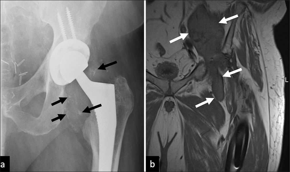 Adverse local tissue reactions caused by hypersensitivity to metal products (ALVAL) in a metal-on-metal hip replacement patient. (a) Plain AP radiograph of the left hip shows metallic debris within the joint capsule (black arrows), and (b) Coronal T1 non FS MRI image demonstrates soft tissue extending along the left iliac and common femoral neurovascular bundle bursa (white arrow) in keeping with ALVAL. FS: Fat saturation, MRI: Magnetic resonance imaging, AP: Anterior-posterior.