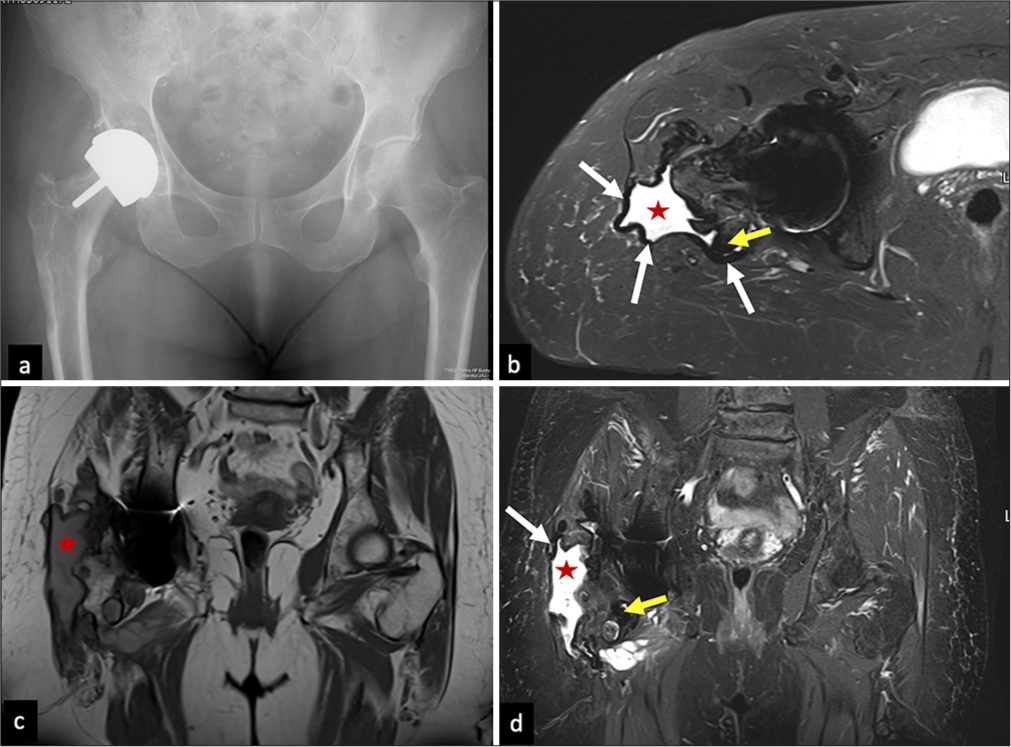 Metallosis: (a) AP pelvis with bilateral hip radiograph of a metal-on-metal right hip resurfacing arthroplasty system. (b) Axial STIR, (c) coronal T1 non FS, and (d) STIR MR images show dehiscence of the posterior pseudo capsule with fluid extending into the trochanteric bursa (red star in b-d), note the markedly hypointense synovial lining (white arrows in b and d) and few hypointense debris (yellow arrows in b and d). FS: Fat saturation, AP: Anteroposterior, STIR: Short tau inversion recovery, MR: Magnetic resonance.