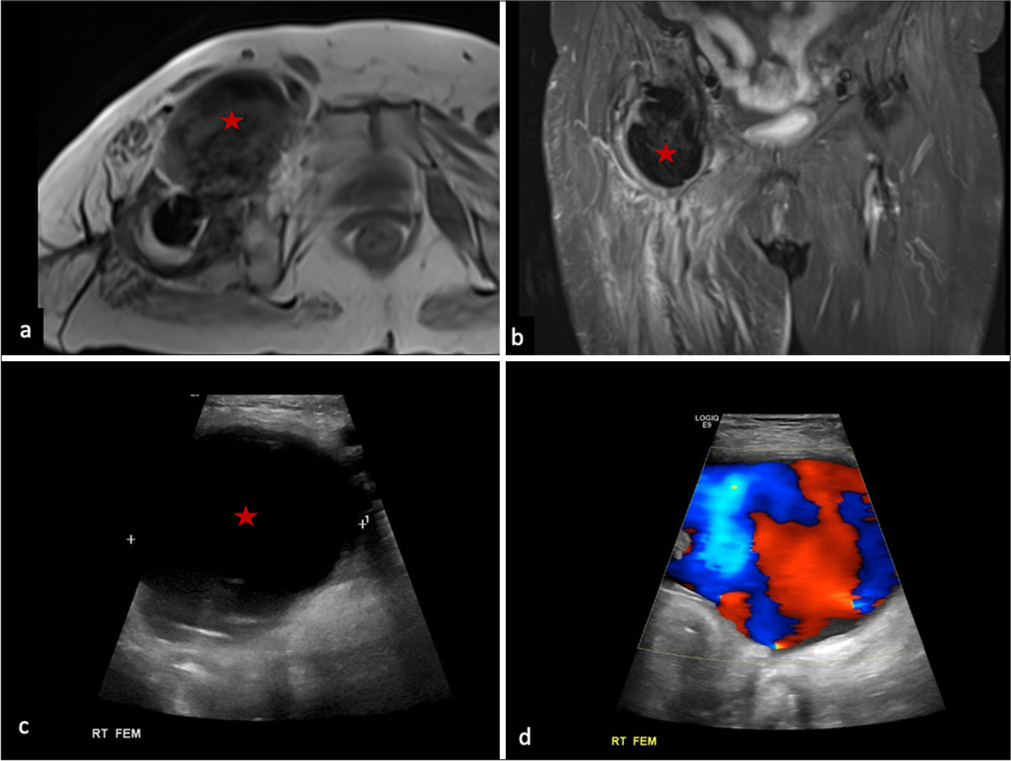 Pseudotumor mimic: (a) T1 non-fs axial and (b) T2 fs coronal MRI in a patient of right total hip arthroplasty showing a large mass-like lesion with T1/T2 hypointense signal anterior to the right hip joint (red star in a and b), based on the MRI findings, a suspicion of pseudotumor formation with hypointense metallic debris within and causing decompression into the iliopsoas bursa can be raised. On ultrasound correlation of the lesion, (c) transverse view greyscale showed a large collection with anechoic internal content with a thin outline (red star), (d) on color doppler image, turbulent flow showing ‘to and fro’ pattern was seen suggesting pseudoaneurysm arising from the right femoral artery.