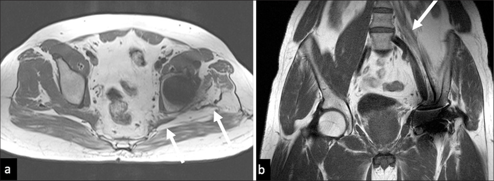 Muscle atrophy. (a) Axial T2W showing severe atrophy of the left Gluteus medius and left piriformis (white arrows) and (b) coronal T1 W image in a different patient showing severe atrophy of the left iliopsoas (white arrow).