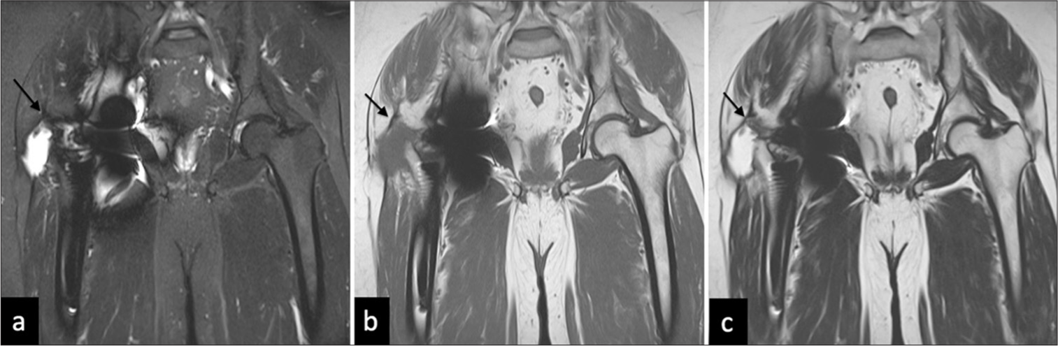 Tendon tear. (a) Coronal STIR, (b) T1W, and (c) T2W images showing avulsion of the right Gluteus medius tendinous insertion from greater tuberosity insertion, with fluid in the trochanteric bursa (black arrows in a-c).