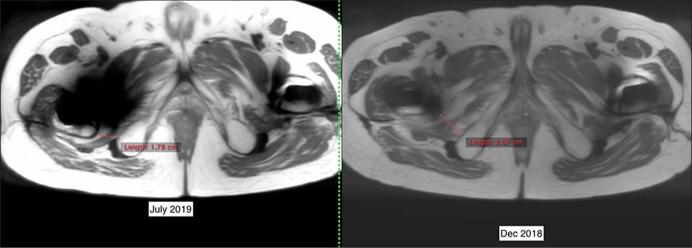 Ischiofemoral Impingement. Axial T2 images obtained a year apart show a narrowing of the ischiofemoral space from December 2018 to July 2019.