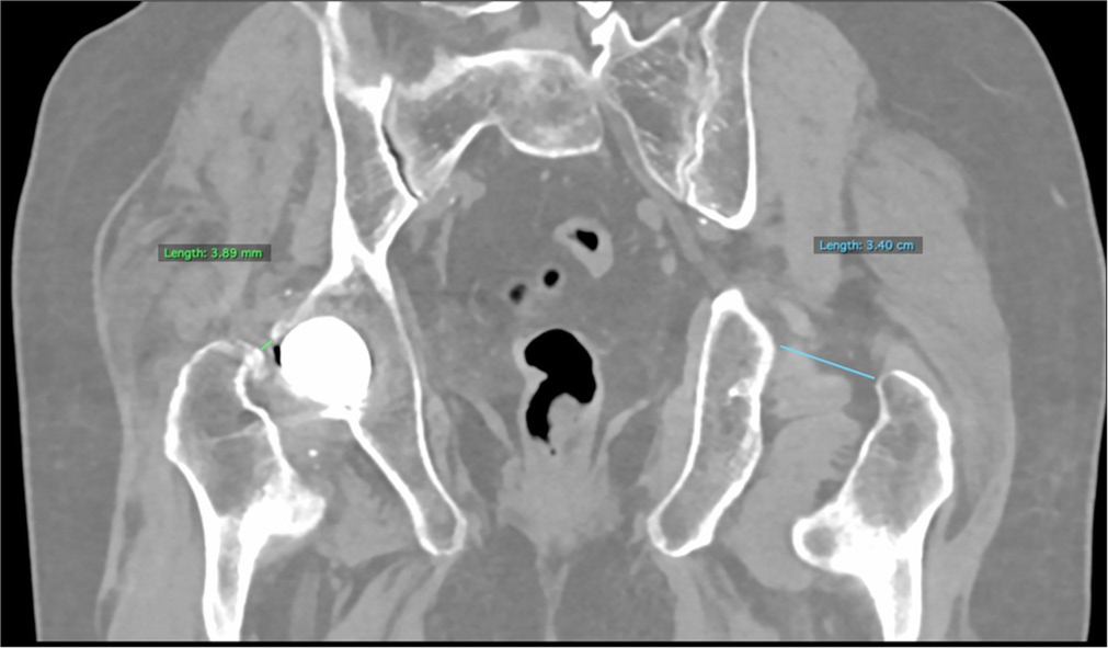 Trochanteric-pelvic impingement. Reconstructed coronal computed tomography images shows decreased trochanteric-acetabulum distance on the right as compared to left – this is consistent with trochanteric pelvic impingement.