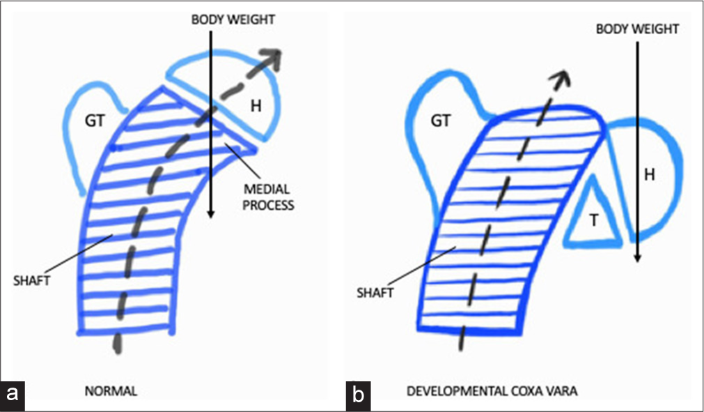 Diagram showing (a) normal femoral development and (b) developmental coxa vara. Normally, the femoral neck is a continuation of the femoral shaft which grows superomedially (black dashed arrow). The medial process of the femoral neck extends along the undersurface of the femoral head/capital epiphysis (H) and plays a significant role in supporting the head from below. In congenital/developmental coxa vara, the space which is normally occupied by the medial process is instead occupied by a triangular fragment of bone (T)/an additional ununited ossification center. The femoral shaft shows upward growth only (instead of the normal superomedial growth) (black dashed arrow). Subsequently, the femoral head is no longer supported by the medial process; it sinks downwards under the pressure of the bodyweight (long black arrow) and eventually coxa vara deformity ensues. GT: Greater trochanter.