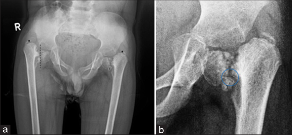 (a) Plain radiograph of pelvis with both hip joints in a 6-year-old boy with waddling gait showing markedly reduced bilateral femoral neck-shaft angle, that is, bilateral coxa vara deformity with poorly developed femoral neck. The orientation of the growth plate was nearly vertical (dotted line). Considerable juxta-metaphyseal-epiphyseal irregularity was present with a triangular bone fragment (T) located inferiorly in the area of the growth plate. The greater trochanters were markedly elevated (asterisk). (b) Magnified radiographic image showing inverted Y-shaped ossification defect (blue ring) at the inferior aspect of the region of femoral neck seen due to ununited triangular bone fragment (T).