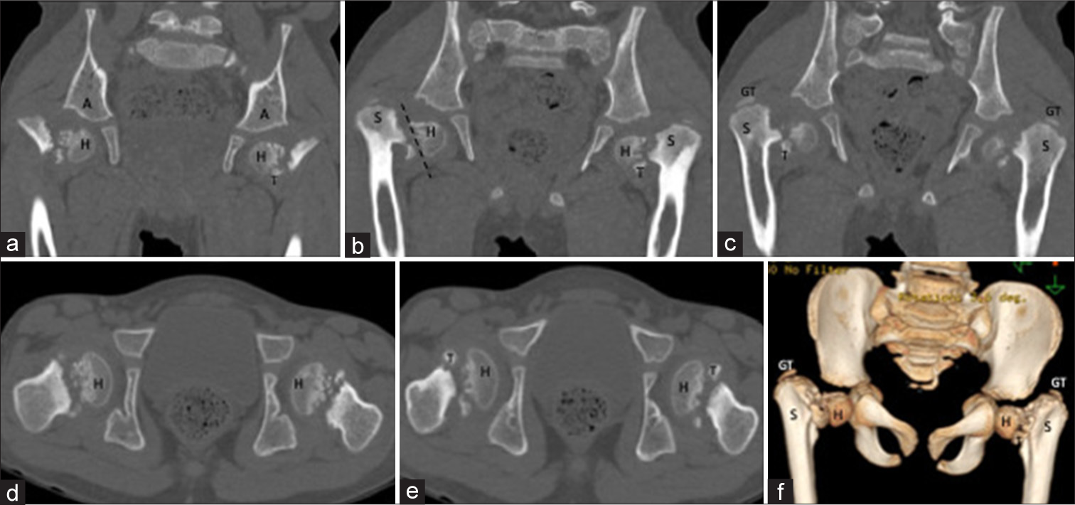 (a-f) Computed tomography images of the patient. (a-c) Serial coronal sections from anterior to posterior, (d and e), serial axial images from superior to inferior, and (f) volume rendered image showing severe bilateral developmental coxa vara. Widening, irregularity and near vertical orientation of the growth plates (dotted line in b) were noted. Inverted Y-shaped ossification defects/triangular metaphyseal fragments (T) were seen at the inferior aspect of the region of femoral neck bilaterally. The femoral neck appeared short and deformed bilaterally. Both acetabuli (A) showed normal development with no sign of dysplasia. The femoral shafts (S) were displaced postero-supero-laterally. The femoral heads (H) appeared osteopenic and showed irregularity and sclerosis at their lateral aspects. The greater trochanters were markedly elevated. GT: Greater trochanter