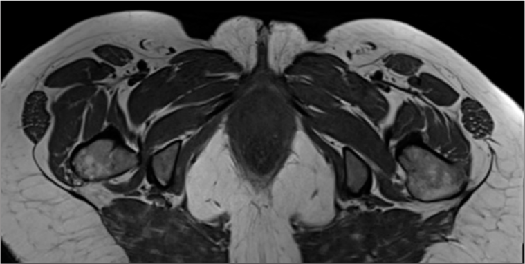 Axial T1 image of pelvis.