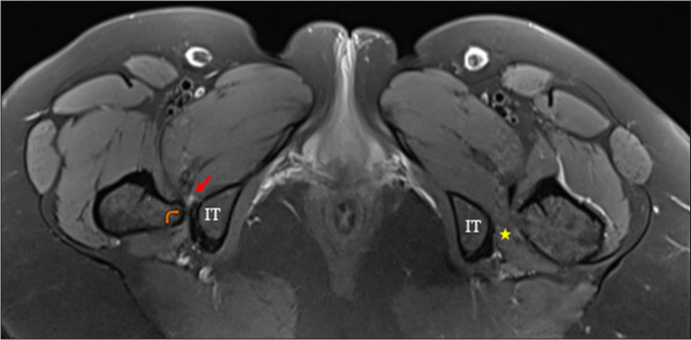 Axial PDFS image of the pelvis demonstrates right ischiofemoral narrowing (orange curved arrow) with severe quadratus femoris muscle compression and edema (red arrows) and normal ischiofemoral space on the left side (yellow star). IT: Ischial tuberosity, PDFS: Proton density fat saturation