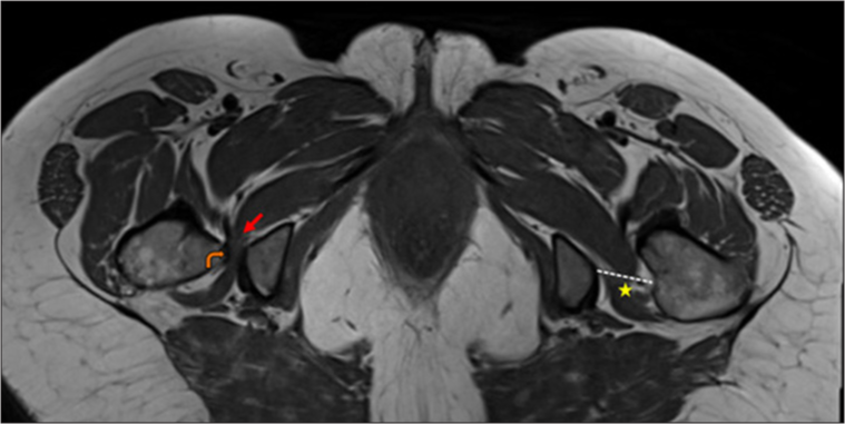 Axial T1 image of pelvis demonstrates right ischiofemoral narrowing (orange curved arrow) with severe quadratus femoris muscle compression and atrophy (red arrows) and normal space on the left side (yellow star and dashed white line).