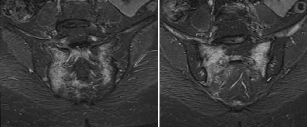 Sequential oblique coronal short tau inversion recovery (STIR) images of sacroiliac joints.