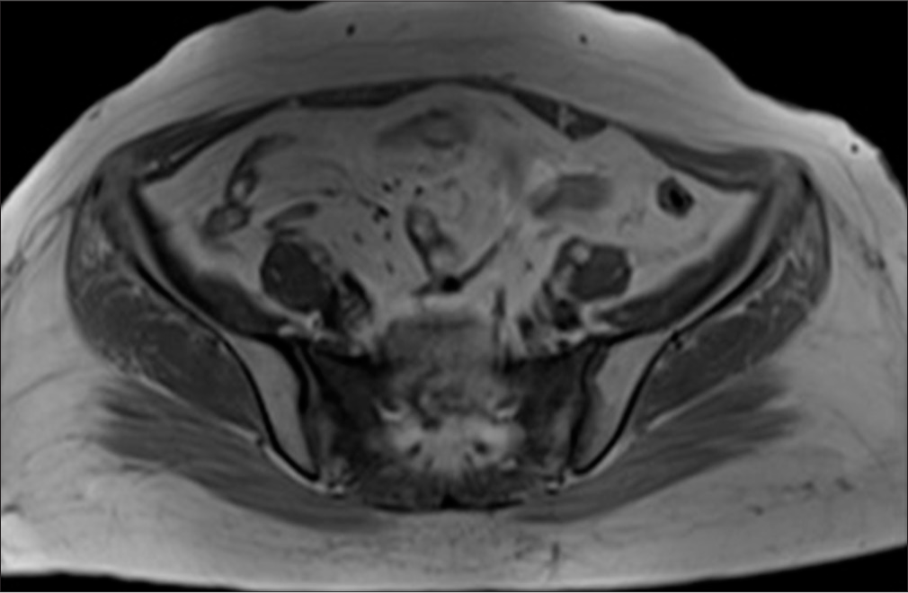 Axial T1 non-fat suppressed image of sacroiliac joints.