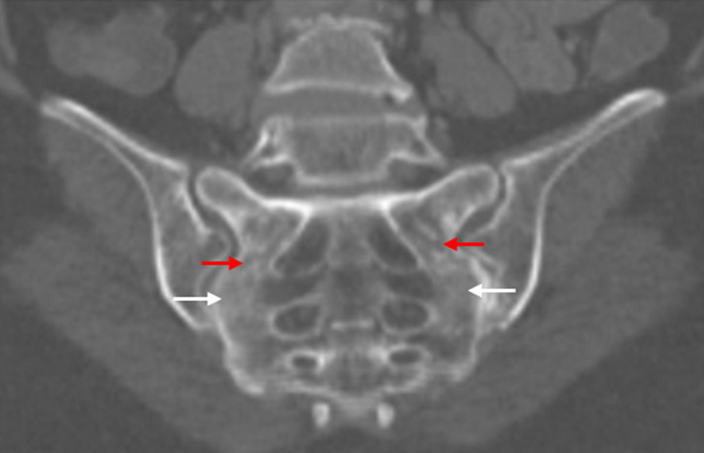 Oblique coronal computed tomography image of sacroiliac joint reveal ill defined sclerosis in bilateral sacral alae (white arrows) with linear lucencies (red arrows) suggestive of fracture line; however, a breach in the cortex is not evident.