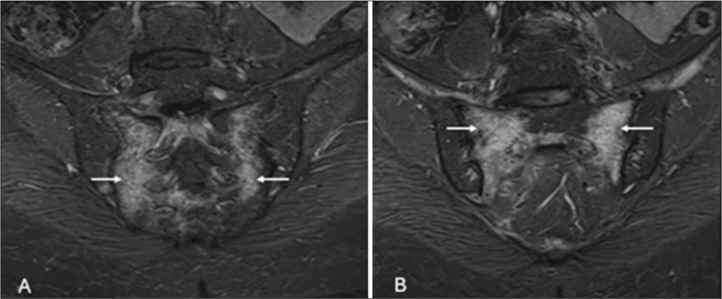 Sequential oblique coronal short tau inversion recovery images (STIR) images of sacroiliac joints reveal: (white arrows in A) STIR hyperintensity s/o edema in bilateral sacral alae lateral to the neural foramina and medial to the sarcoiliac joints and (arrows in B) hypointense fractures lines parallelly oriented to the sacroiliac joints.